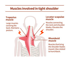 Muscle sets in the back that cause tight shoulder