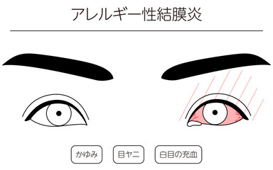 医療イラスト、眼病・アレルギー性結膜炎の線画イラスト