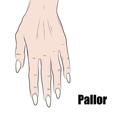 Paleness can be caused by: Anemia (blood loss, poor nutrition, or problems with the circulatory system).