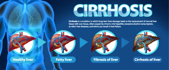 Fotobehang Informative poster of alcoholic liver disease Cirrhosis © blueringmedia