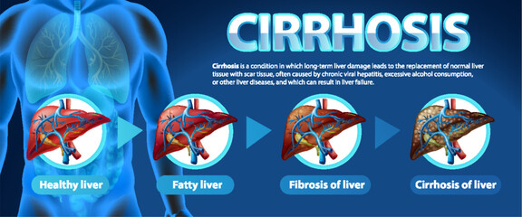 Informative poster of alcoholic liver disease Cirrhosis