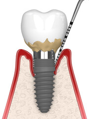 3d render of human gums cross-section with peri implantitis disease and periodontal sonda - obrazy, fototapety, plakaty