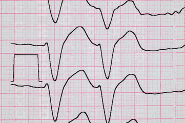ECG with rhythm disturbance, ventricular extrasystole close-up.Premature contraction of the ventricles