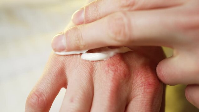 Man smearing moisturizer on dry skin of hand close-up