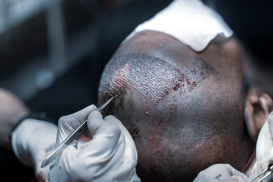 FUE hair Transplant Patient in Clinic. Hair transplant patient in the end of the operation