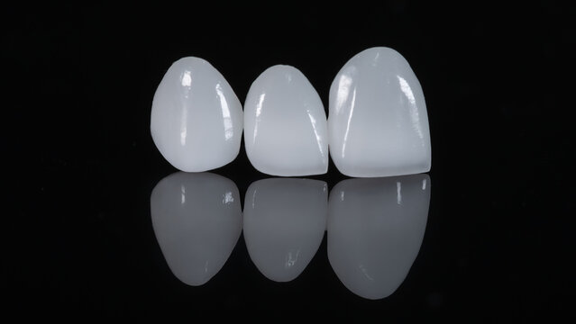 Porcelain dental veneers