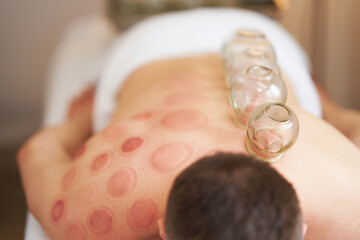 A picture of a man having cupping therapy