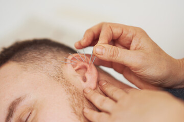 A picture of a man having acupuncture on ear - obrazy, fototapety, plakaty