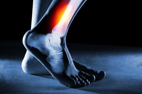 Human foot ankle and leg in x-ray on blue background. The foot ankle is highlighted by red-yellow colour.