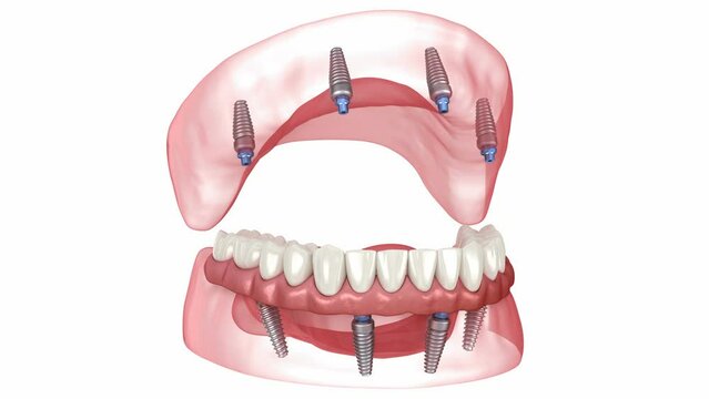 Prostheses supported by 8 implants. Dental 3D animation