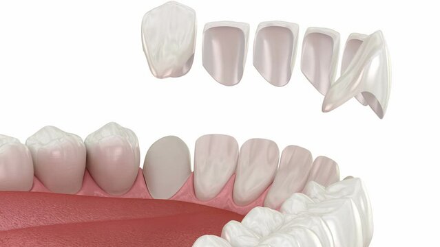Dental veneer placement procedure. Dental 3D animation