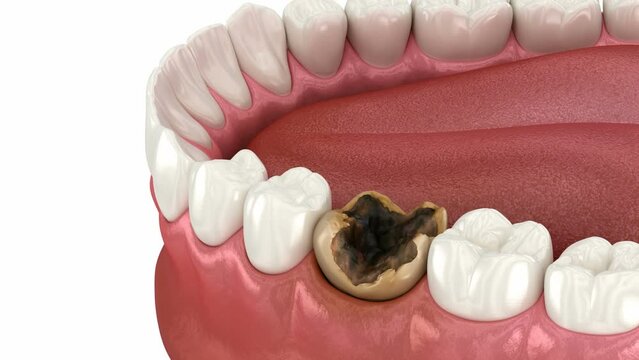 Extraction of damaged tooth. Dental 3D animation
