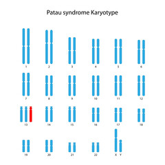 Patau syndrome (trisomy 13) human (male) karyotype