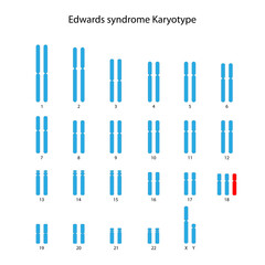 Edwards syndrome (trisomy 18) human (male) karyotype