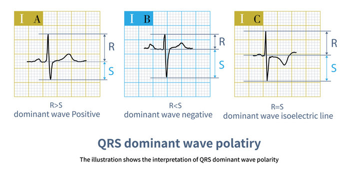 R wave greater than S wave is judged to be positive; R smaller than S  is judged to be negative; R equal to S amplitude is judged to be equipotential.