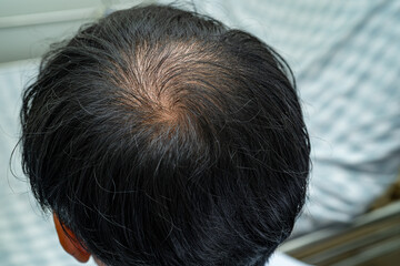 Bald in the middle head and begin no loss hair glabrous of mature Asian business smart active office man.
