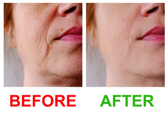 close-up part of female face of woman 40-50 years old with age wrinkles, facial wrinkles before and...