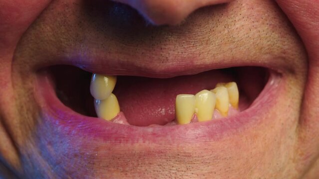 Periodontal disease and missing teeth in an elderly man. Close up shot of a toothless male mouth. Man showing his rotten teeth, caries, decayed and weak enamel, teeth falling out, dental problems