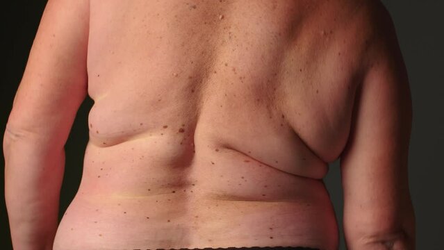 Close up back of fat woman. Woman bends to the side, folds of skin and fat on her back. Weight loss or weight gain