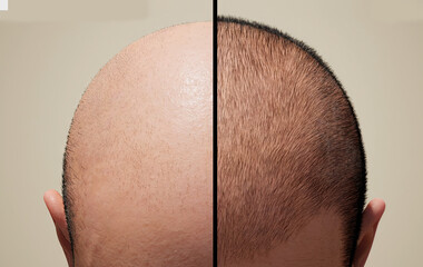 The head of a balding man before and after hair transplant surgery. Man before after hair loss treatment. Head balding man before after hair. 