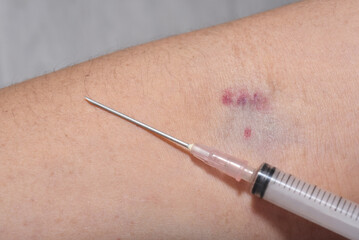 Petechiae from broken blood vessels after blood draw on woman's arm
