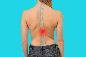 Woman with scoliosis of the spine. Curved woman's back. Severe pain in the lower thoracic spine
