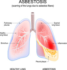 asbestosis lungs. Inflammation and scarring of the lungs