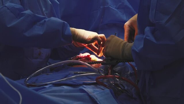 A team of surgeons in a hospital open heart surgery in the operating room. A beating human heart in an open-chest surgical chest during heart surgery.