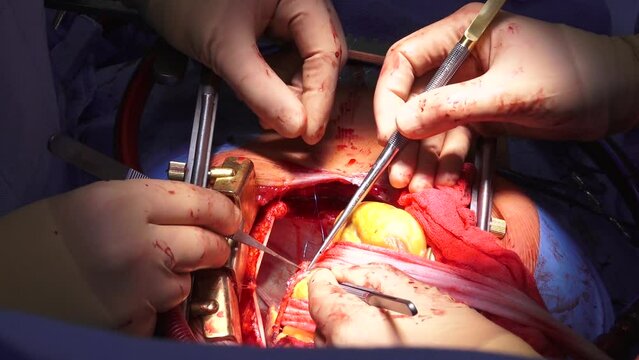 A team of surgeons in a hospital open heart surgery in the operating room. A beating human heart in an open-chest surgical chest during heart surgery.