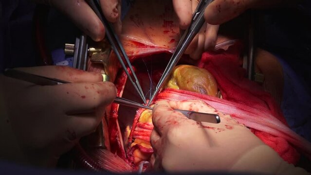 A team of surgeons in a hospital open heart surgery in the operating room. A beating human heart in an open-chest surgical chest during heart surgery.