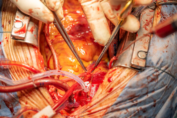 Two heart surgeons prepare a vein to be able to create a bypass on the heart. Concept: health and...