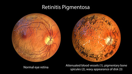 Retinitis pigmentosa, a genetic eye disease leading to vision loss. 3D illustration shows normal eye retina and pigment depositis in the affected retina - obrazy, fototapety, plakaty