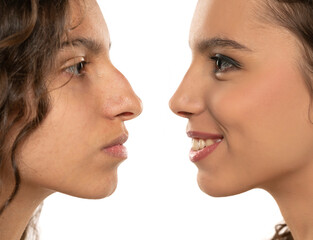 Woman Rhinoplasty. Women Nose Shape Before and After Plastic Surgery. Woman Profile Side View over...