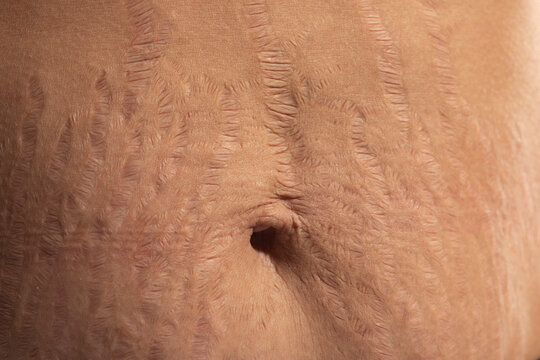 Close up human Skin natural stretch marks Texture background