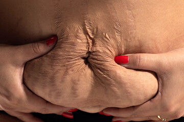 Woman displaying loose skin and stretch marks after pregnancy