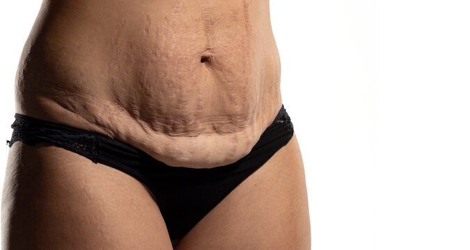 Woman with loose skin and stretch marks on her belly after pregnancy