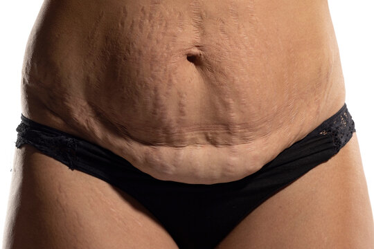 Woman with loose skin and stretch marks on her belly after pregnancy