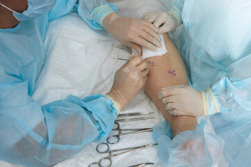Doctor with assistant in sterile surgical gowns performs operation on patient's leg during operation. Vascular surgeon prepared for incision of marked veins for surgery to remove varicose veins