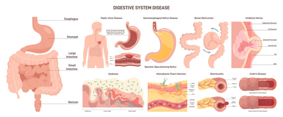 Digestive system diseases set. Gastroenterology disorder, internal