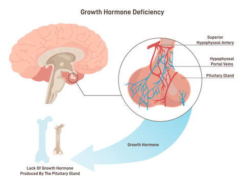 Growth hormone deficiency. Syndrome characterized by insufficient