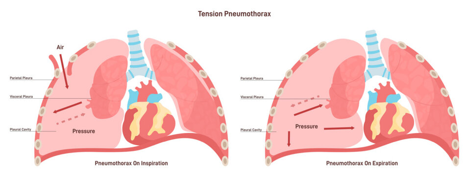 Pneumothorax. Abnormal gathering of air in pleural space. Collapsed lung.
