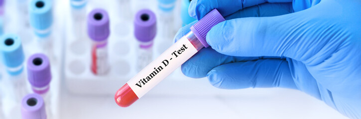 Doctor holding a test blood sample tube with Vitamin  D  test on the background of medical test...