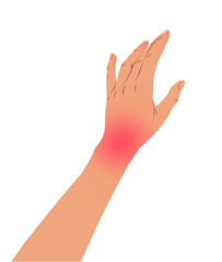 Vector illustration of left hand with carpal tunnel syndrome