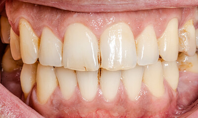 Front view of dental arches in occlusion, lips and cheeks retracted. Unhealthy teeth with barely...