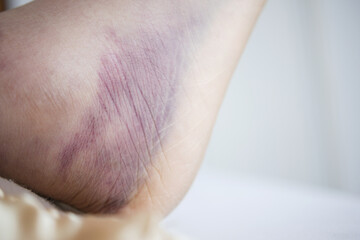 Fototapeta premium close up of women feet with swelling 