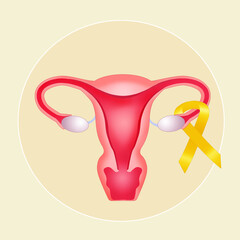 an illustration of uterus for endometriosis