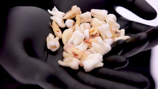 close-up handful of teeth in hands of black latex gloves caries pull out teeth stomatology dental treatment untreatable doctor