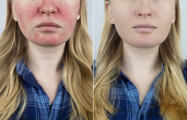 Rosacea face. The girl suffers from redness on her cheeks. Couperosis of the skin. Redness and...
