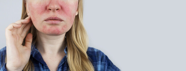 Rosacea face. The girl suffers from redness on her cheeks. Couperosis of the skin. Redness and capillary mesh are visible on the face. Treatment and removal. Vascular surgery and dermatology