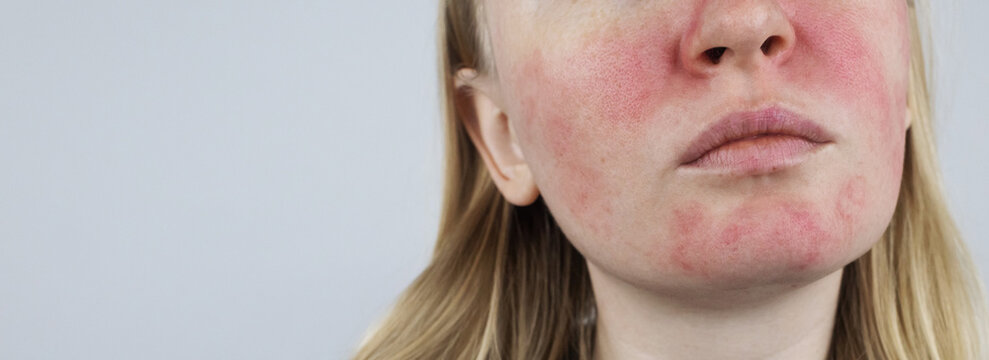 Rosacea face. The girl suffers from redness on her cheeks. Couperosis of the skin. Redness and capillary mesh are visible on the face. Treatment and removal. Vascular surgery and dermatology